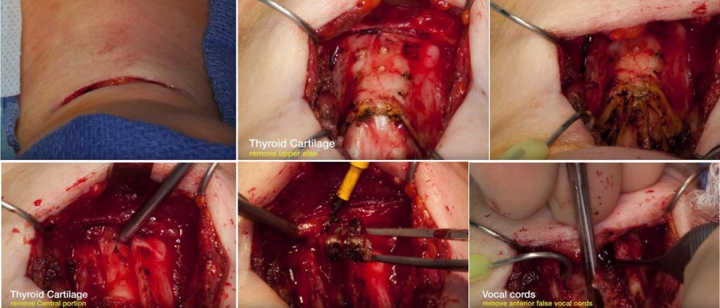 Laringoplastia de thomas foto del proceso de cirugia