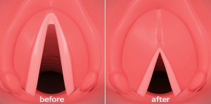 Chirurgie cordes vocales dessin explicatif